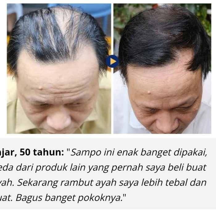 Promo Hair Growth Dht Blocker Serum & Shampoo Penumbuh Rambut Herbal Alami Cod