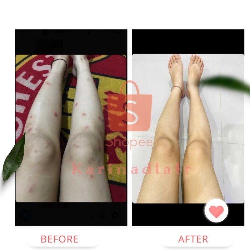 MD Penghilang Bekas Luka dan Keloid Scars Cream Removel