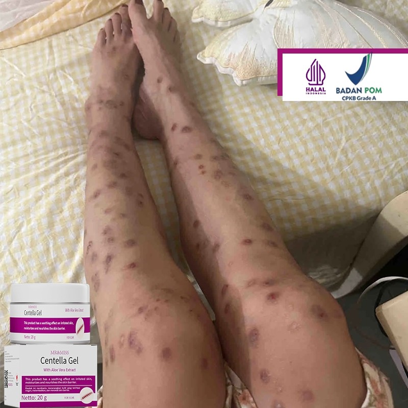 Penghilang bekas luka hitam koreng salep penghilang bekas luka hitam salep keloid paling ampuh 20ml