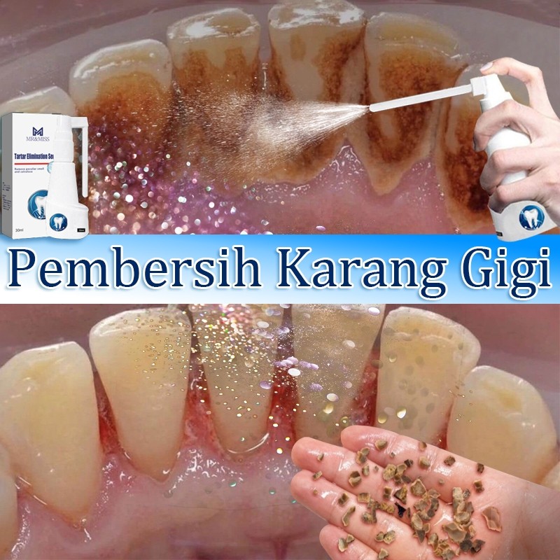 Alat pembersih karang gigi Penghilang karang gigi penghilang karang gigi membandel 30ml penghilang