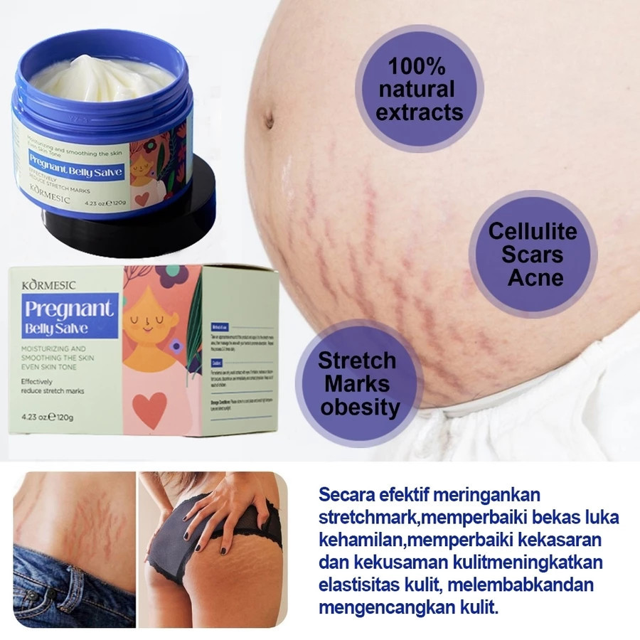 Krim Stretch Mark Herbal, efektif menghilang stretch mark, garis-garis lemak, penghilang stretch