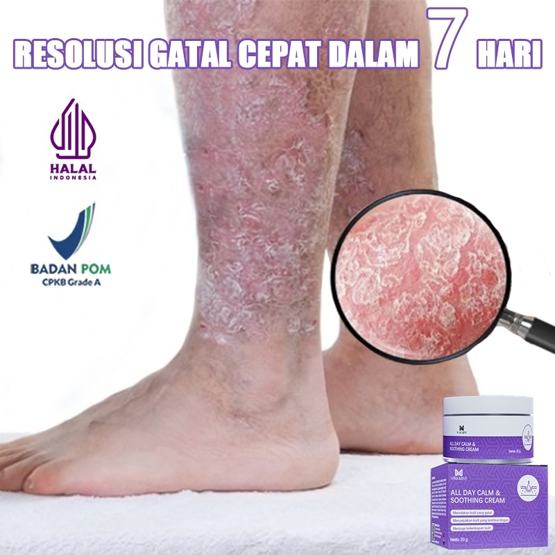 layla Salep selangkangan gatal dan jamur salep gatal selangkangan salep gatal eksim paling ampuh 20g