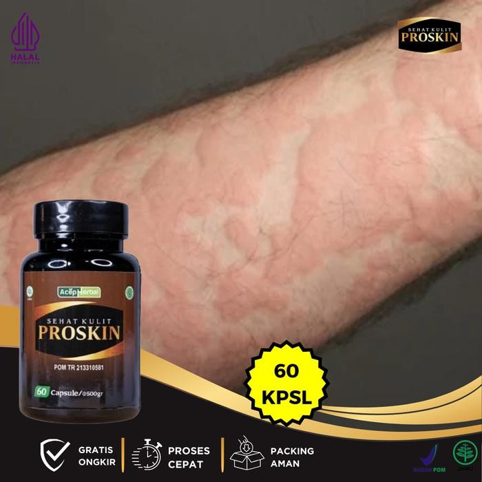 Biduran Dan Gatal Gatal, Alergi Kulit Gatal Bentol Biduran, Gatal Biduran Kapsul, Alergi Dingin,