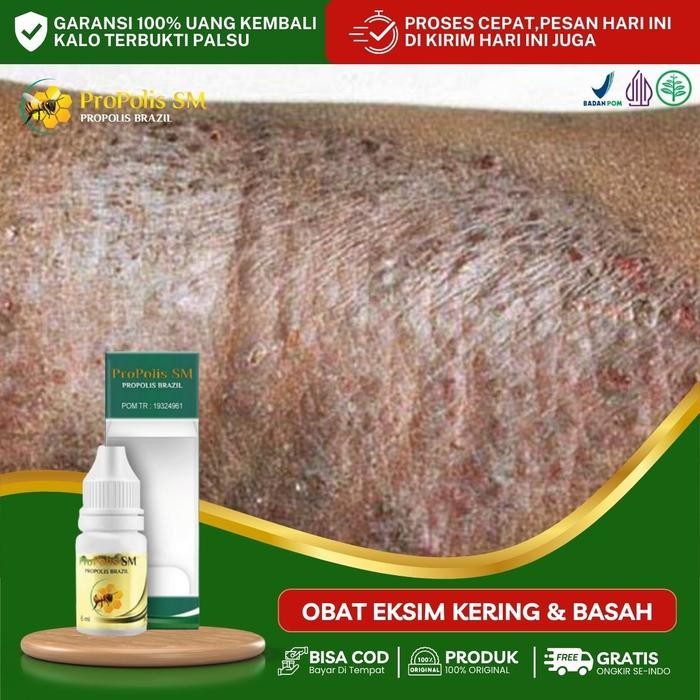 Propolis Untuk Penyakit Kulit Eksim, Eksim Basah, Eksim Kering, Eksim Bernanah, Gatal Eksim, Koreng,