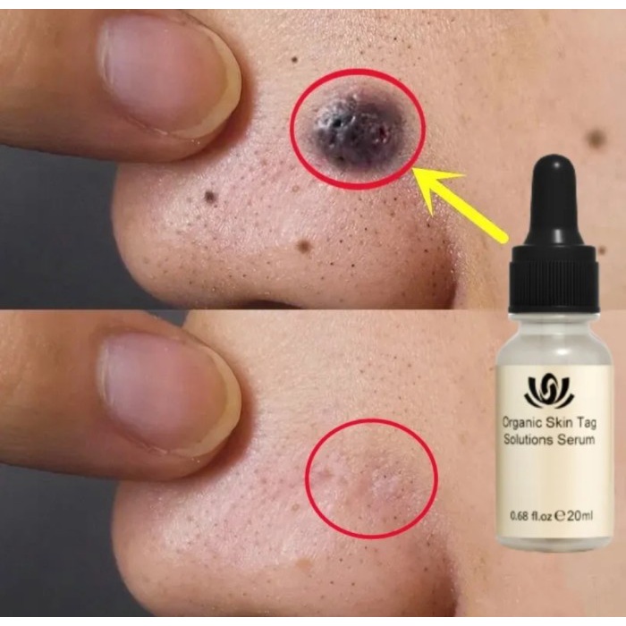 Ori 100% Rose Mole Serum Penghilang Tahilalat Kutil Skin Tag Remover
