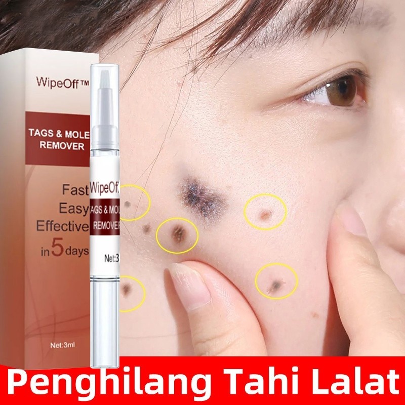 Penghilang kutil Wart Remover Pen Penghilang Tahi Lalat Penghilang Kutil Skin Tag Remover