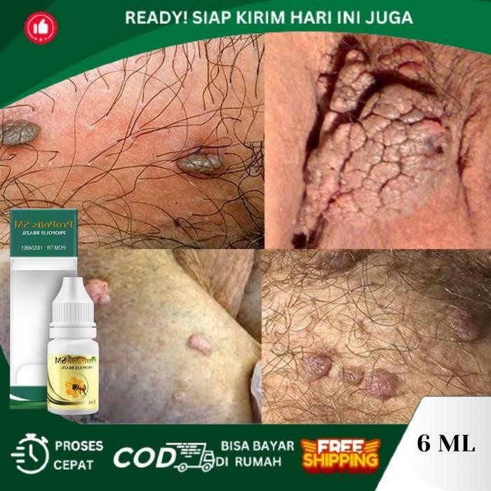 Propolis SM Kutil Kelamin HPV, Penghancur Kutil Kelamin, Jamur Kelamin, Kutil Di Ketiak