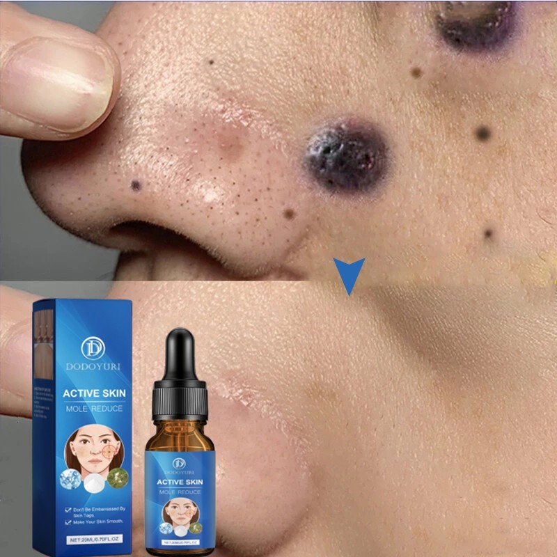 Penghilang tahi lalat penghilang tahi lalat di wajah obat penghilang tahi lalat penghilang tailat