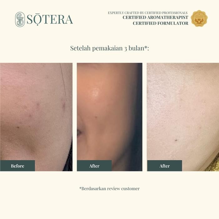 

Terlaris Sotera Kunyit Asam Soap / Sabun Natural Untuk Bekas Jerawat Beruntusan Noda Hitam / Sabun