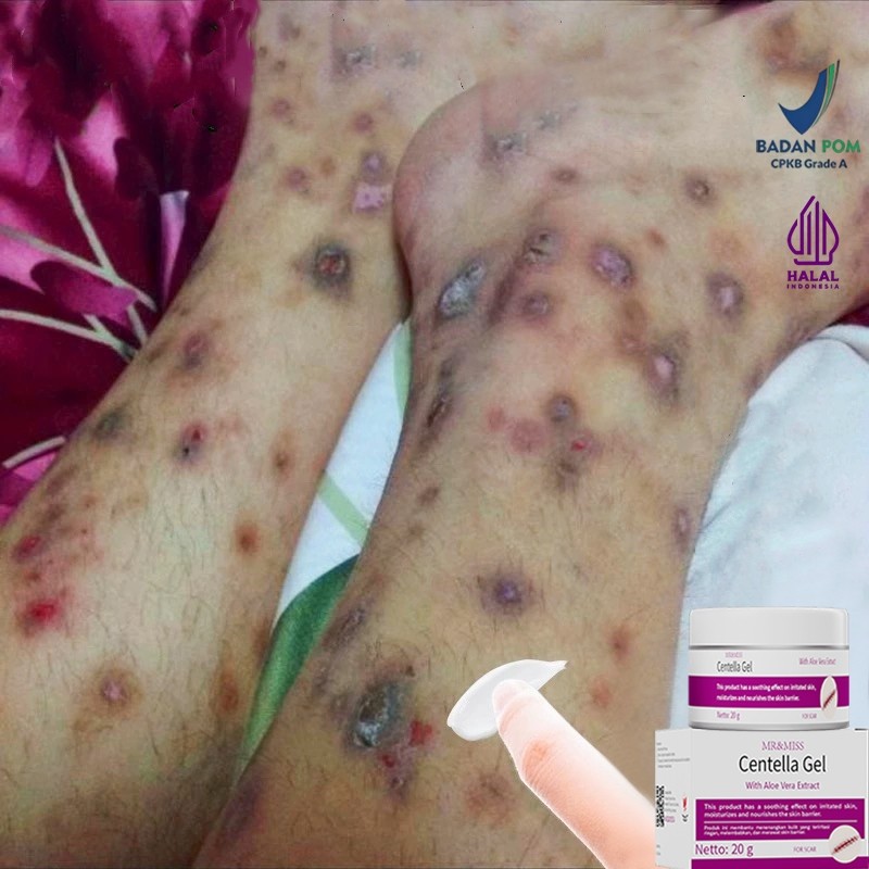 Penghilang bekas luka hitam koreng penghilang bekas luka anak salep penghilang bekas luka obat