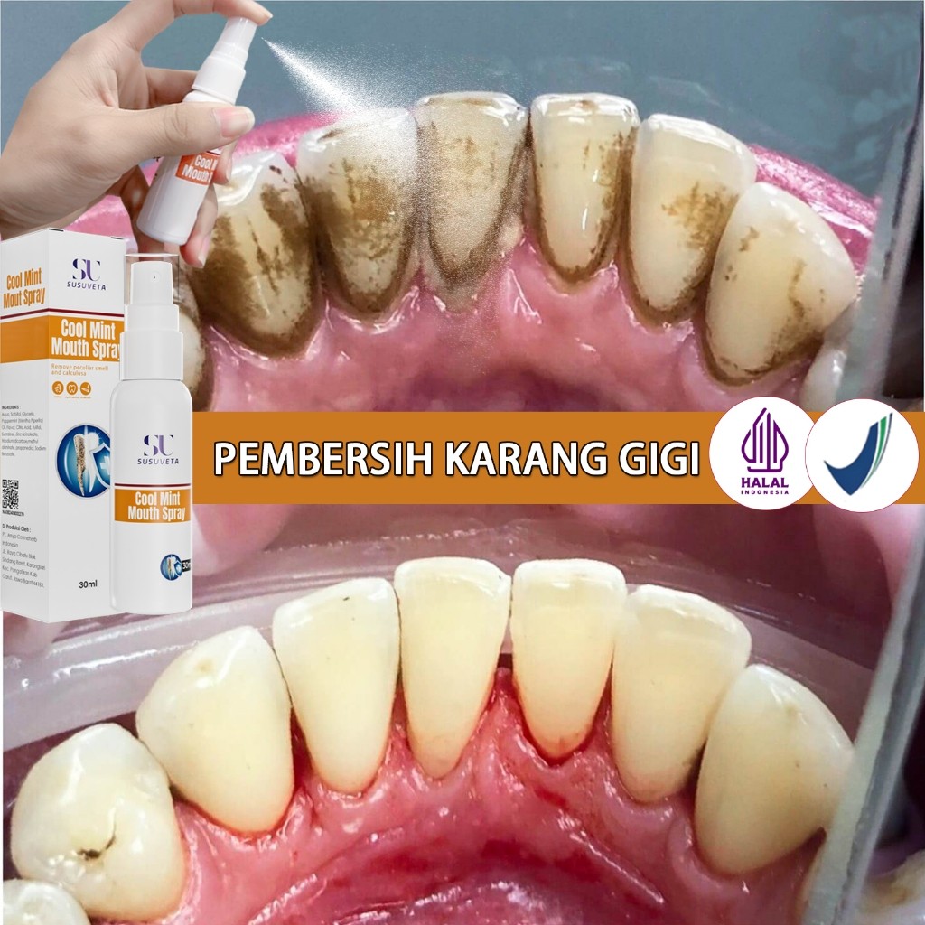 BPOMPembersih gigi kuning dan karang Penghilang karang gigi membandel perontok karang gigi paling