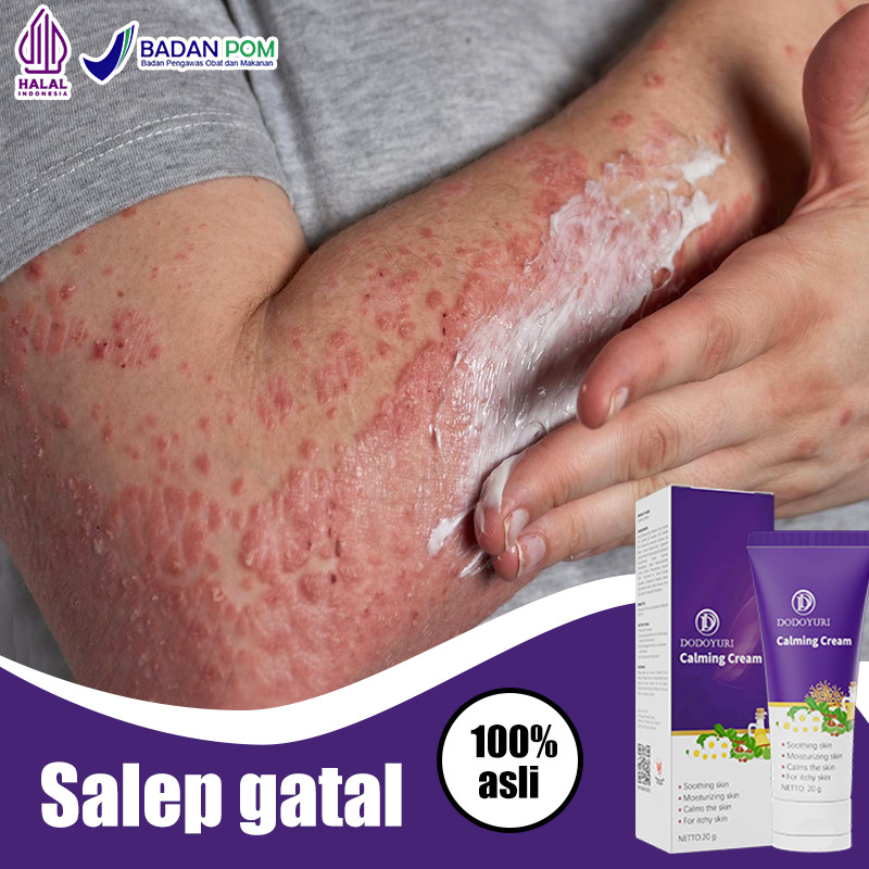 Salep gatal salep china gatal paling ampuh obat gatal obat eksim salep gatal selangkangan 20g obat