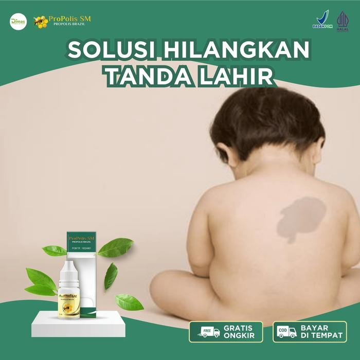 Penghilang Tanda Lahir, Tanda Lahir Di Muka, Tanda Lahir Coklat, Tanda Lahir Merah, Menghilangkan