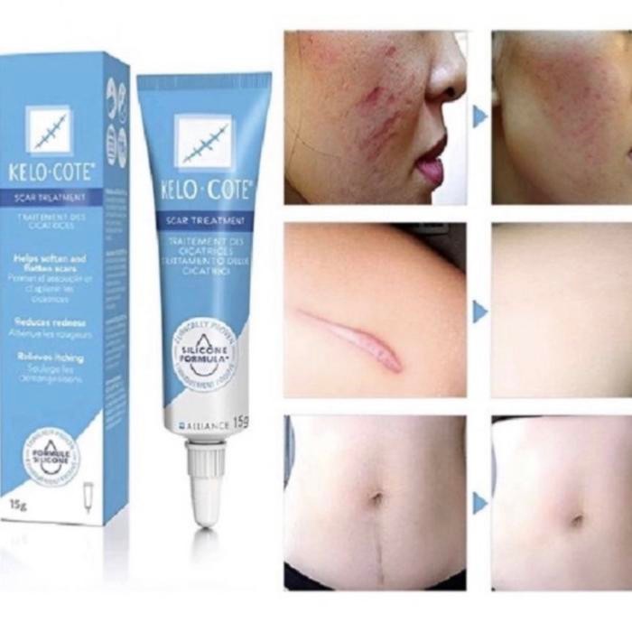 ready stok kelo cote gel asli penghilang bekas luka operasi original