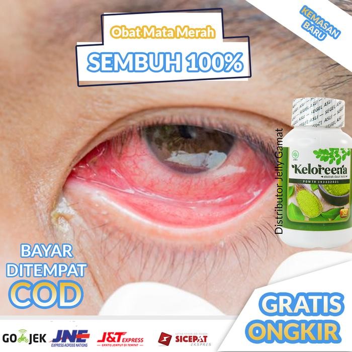 Obat mata merah dan gatal, Iritasi mata, Radang mata, infeksi mata