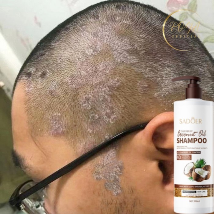 Shampo anti ketombe Penghilang ketombe dan gatal Obat psoriasis