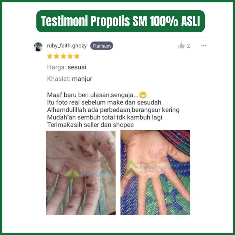 Penghilang Bekas Koreng, Obat Korengan Bernanah, Obat Bekas Koreng Hitam, Korengan di Kaki, Obat