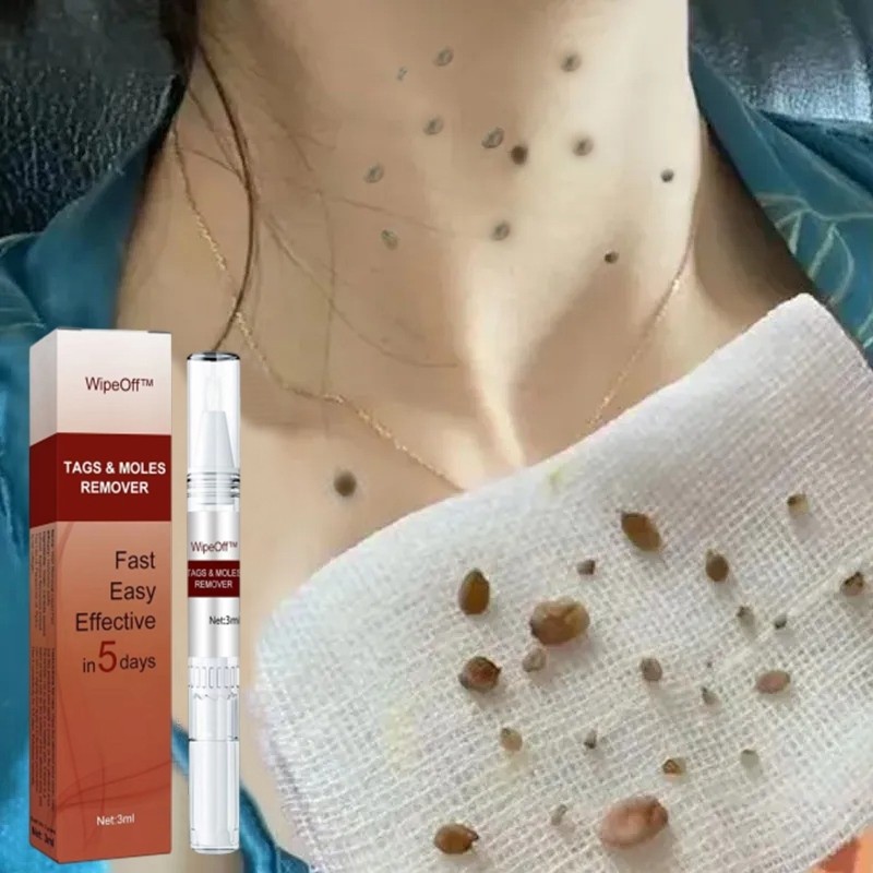 Obat kutil penghilang kutil dan tahi lalat obat kutil paling ampuh penghilang tahi lalat obat kutil