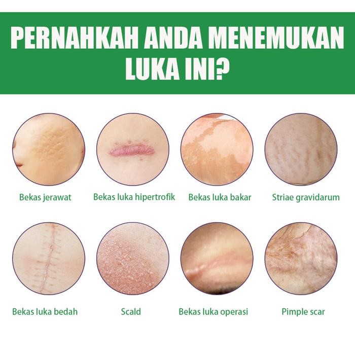 SILICONE SCAR SHEET PLESTER SILIKON PENGHILANG KELOID BEKAS LUKA SILICON KELOID PLESTER BEKAS LUKA
