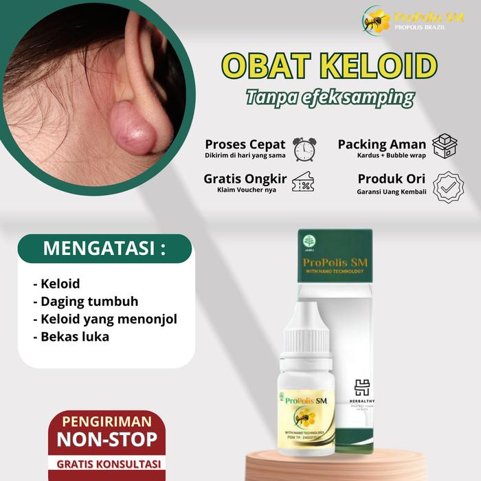 Tetes Keloid, Penghilang Keloid, Keloid Menahun, Penghilang Keloid Yang Membesar, ProPolis SM