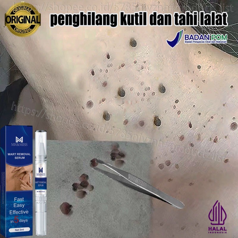 Penghilang kutil dan tahi lalat Penghilang tahi lalat di wajah Obat kutil Obat Penghilang Kutil 100%