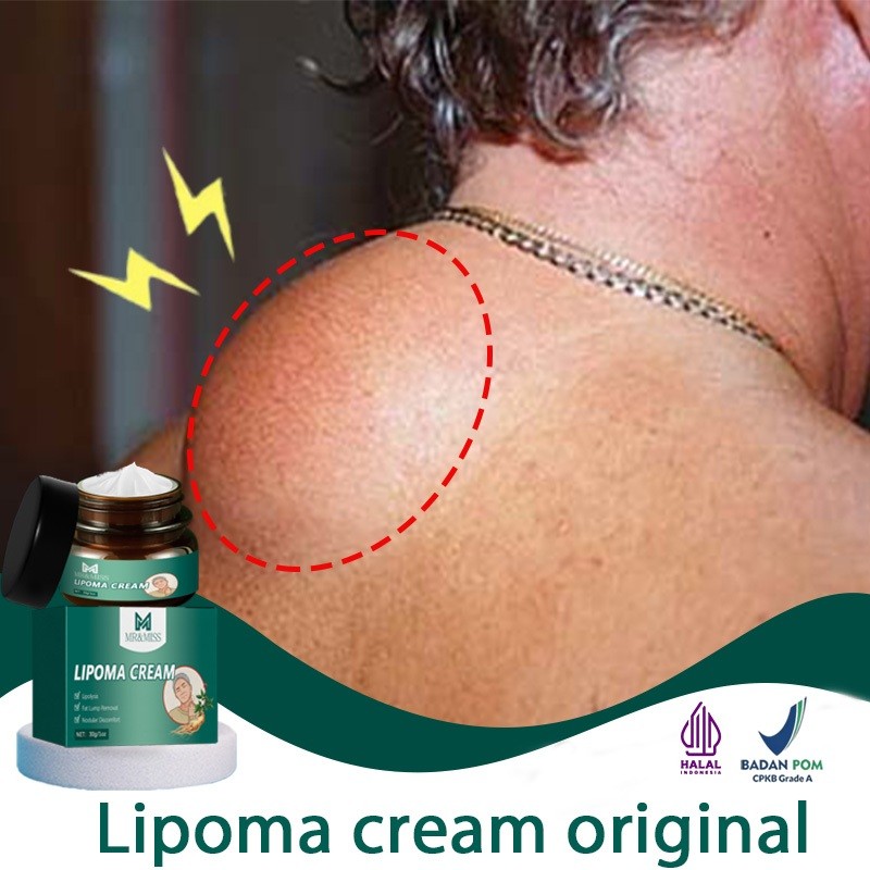 Obat benjolan lipoma cream original lipoma cream obat lipoma 30g lipoma removal cream original salep