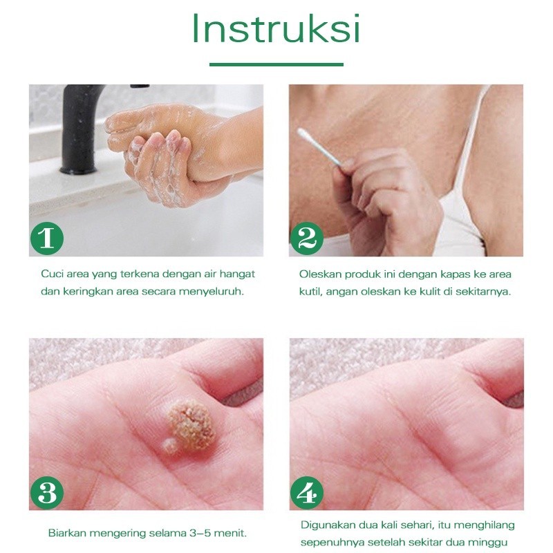 RB22 Penghilang tahi lalat penghilang tahi lalat di wajah obat penghilang tahi lalat penghilang