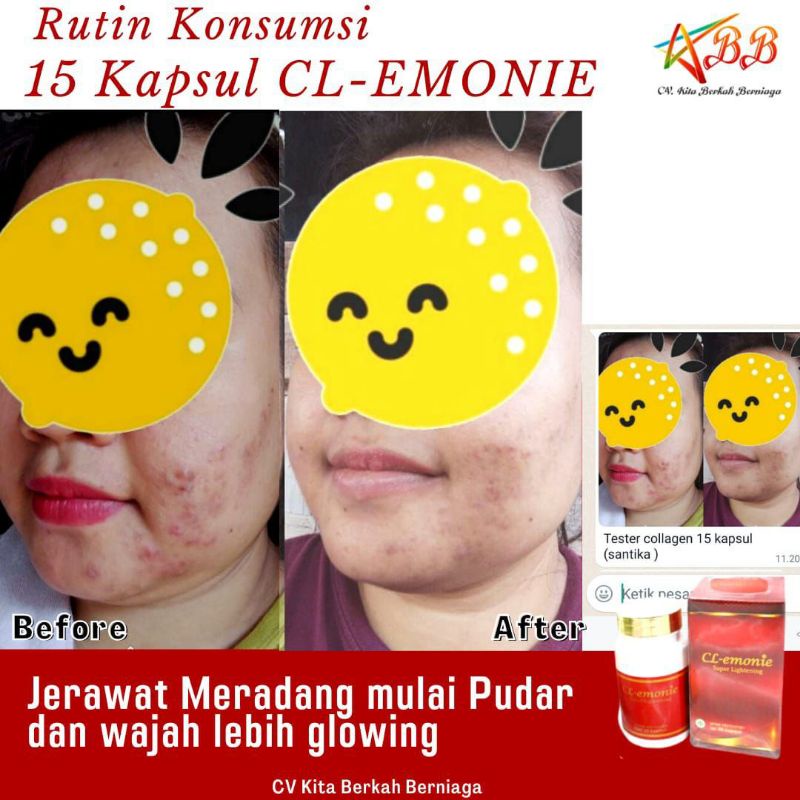 Beauty Kolagen Lemonieskin/Cl-Emonie Lemonieskin/Suplemen Kolagen Dlemonie