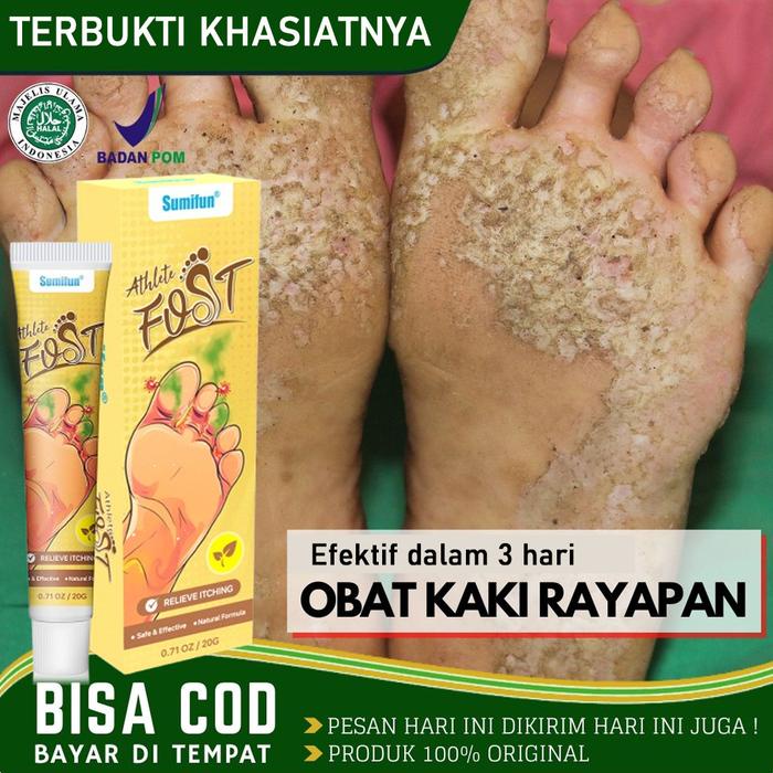 Salep Gatel2 Paling Obat Telapak Kaki Rayapan 20G Salep Gatal Kulit Ampuh Obat Kaki Rayapan Bolong2