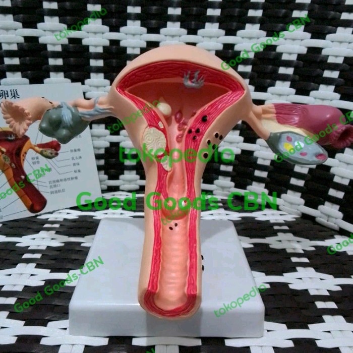 Sale Terbatas Alat Peraga Uterus Ovary Disease / Model Anatomi Human Female Uterus