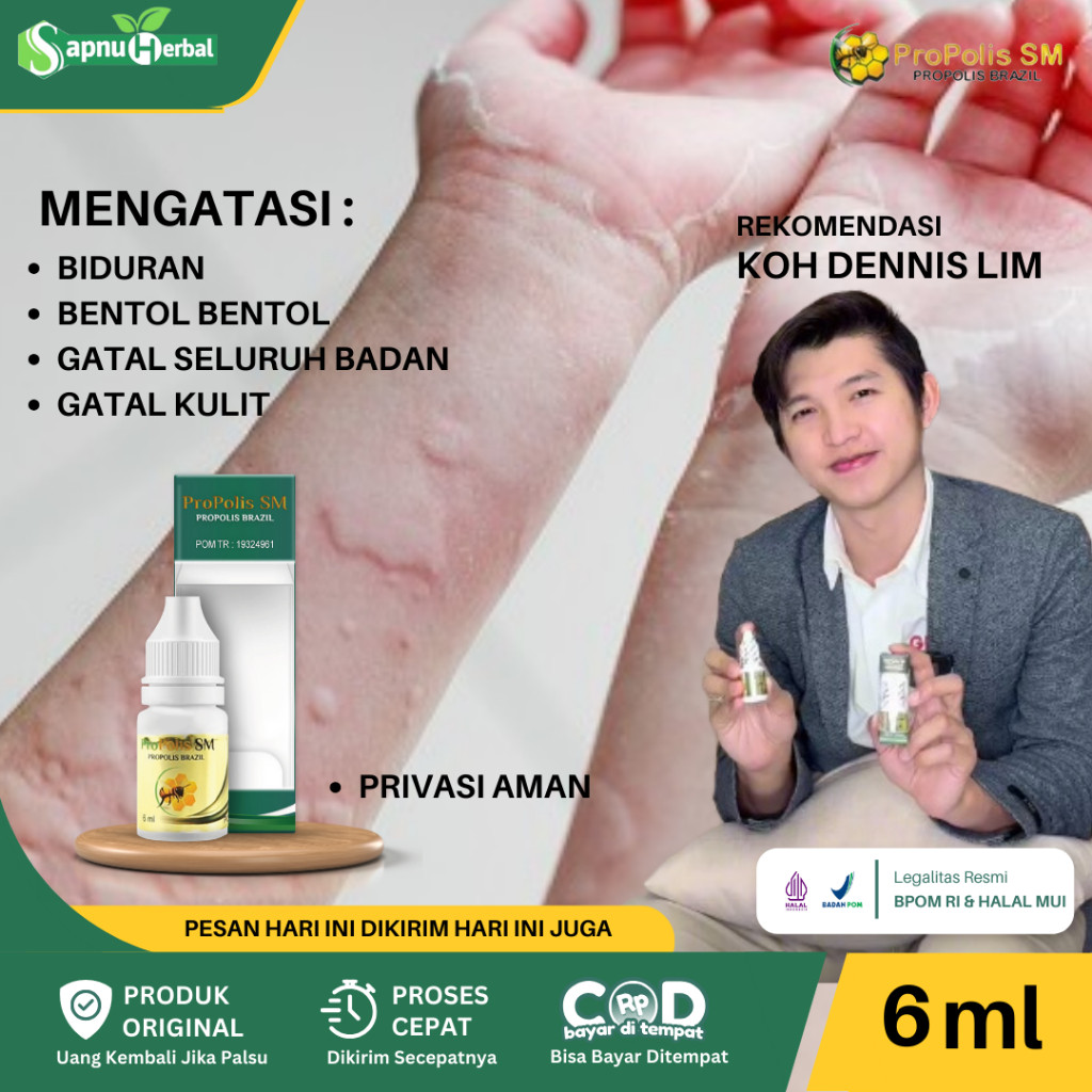 OBAT GATAL SELURUH BADAN, KULIT GATAL, GATAL SELANGKANGAN, GATAL KULIT BERSISIK, PSORIASIS, EKSIM,