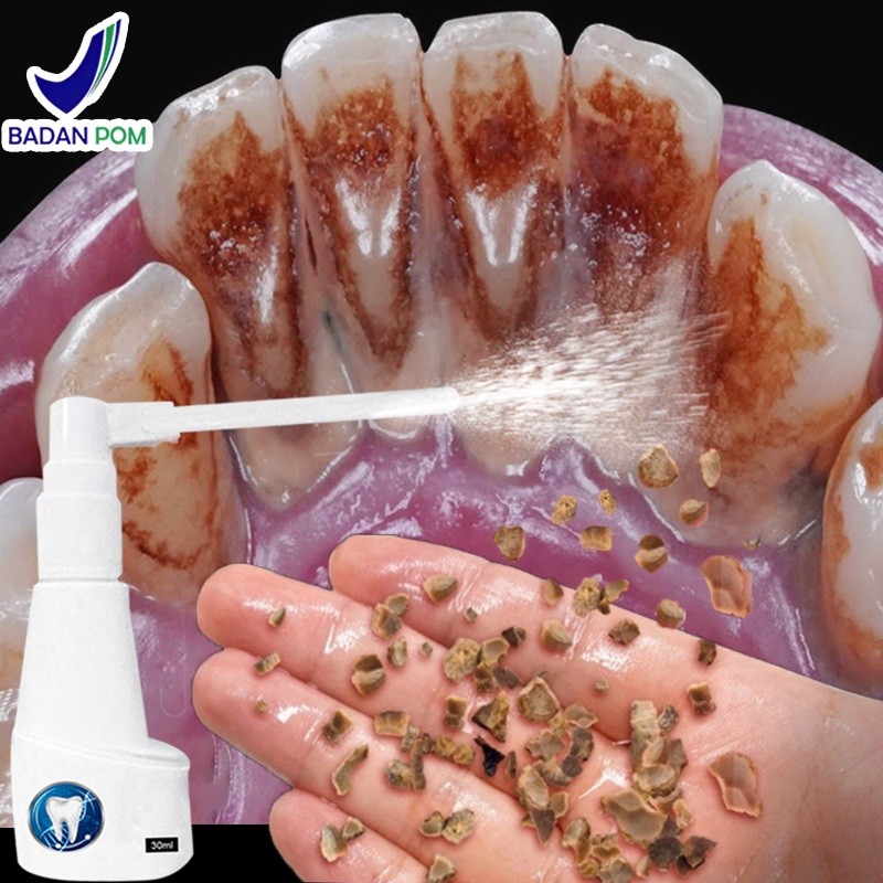 Perontok karang gigi Penghilang karang gigi Perontok karang gigi paling ampuh 30ml alat pembersih