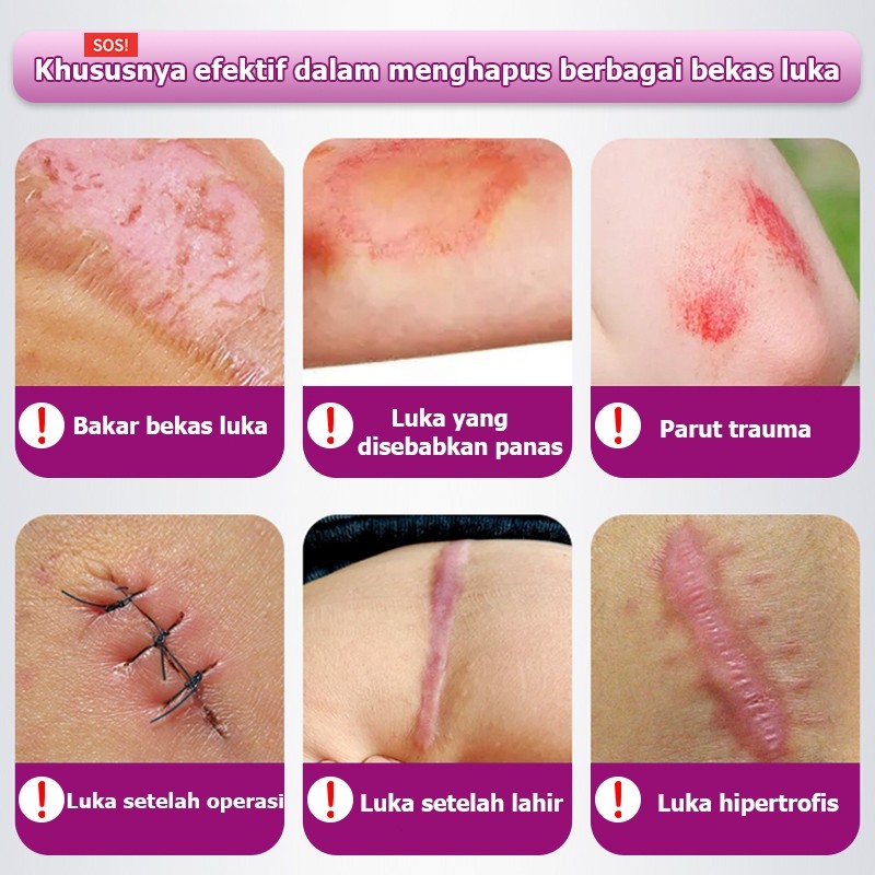 Penghilang bekas luka hitam koreng salep penghilang bekas luka penghilang bekas luka anak 20g