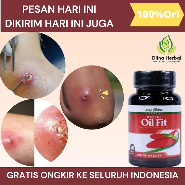 Bisulan Dipantat, Bisul Bernanah, Bisul Gak Tumbuh Lagi, Bisul Di Kemaluan, Penghilang Bisul, Bisul