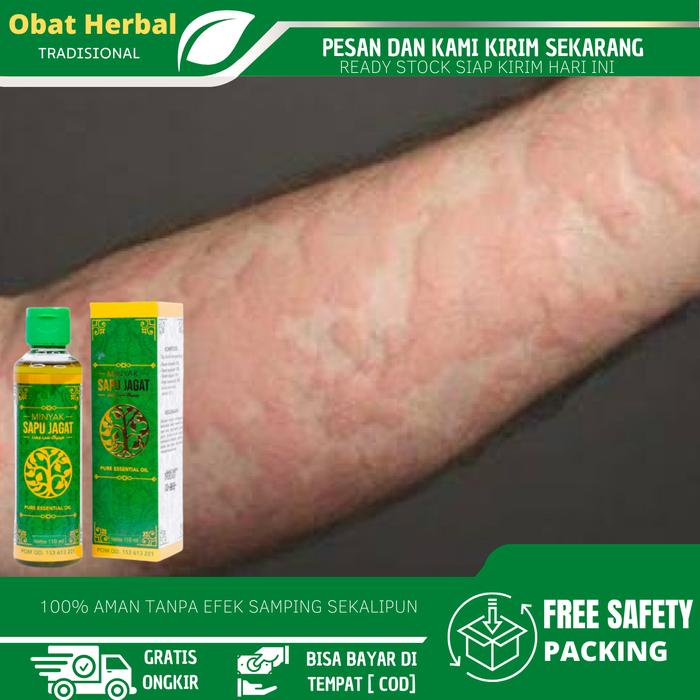 Minyak Balur Gatal Kulit, Gatal Kulit Alergi Dingin, Gatal Eksim, Psoriasis, Gatal Gatel Alergi,