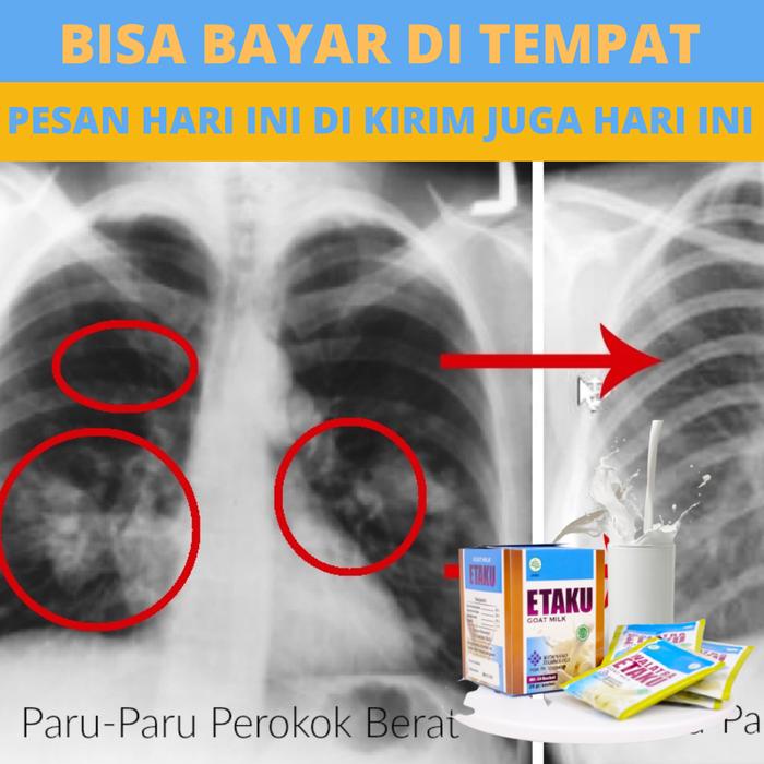 

terbaru !!! susu etawaku - bersihkan paru - paru atasi masalah pernapasan asma sesak nafas pneumonia