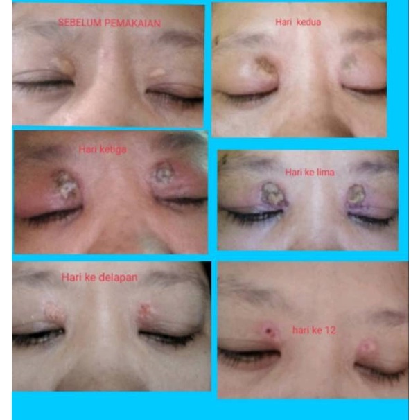 Paket Xanthelasma - obat salep xanthelasma 10gr dan minyak xanthelasma 5 ml - hilangkan lemak mata