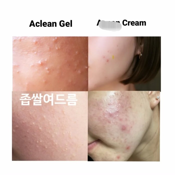 [Pasti Ori] Acne Treatment Korea Dong A Cream Gel Anti Jerawat Scar Noda Bekas Jerawat Keloid Milia
