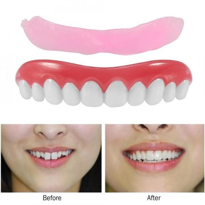 gigi palsu veneers atas