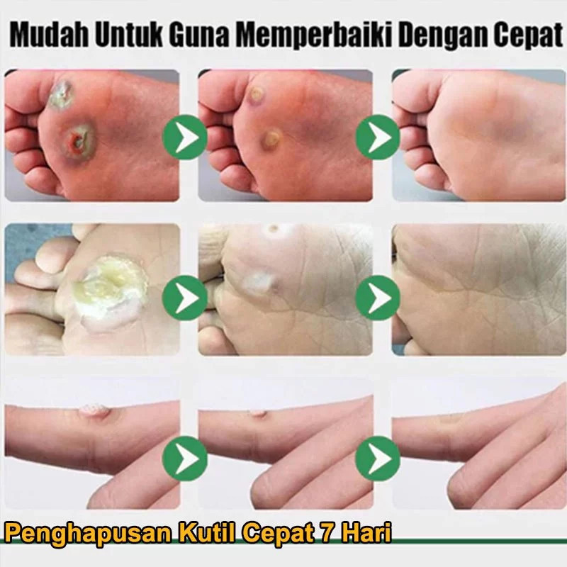 Penghilang tahi lalat penghilang tahi lalat di wajah obat penghilang tahi lalat penghilang tailat