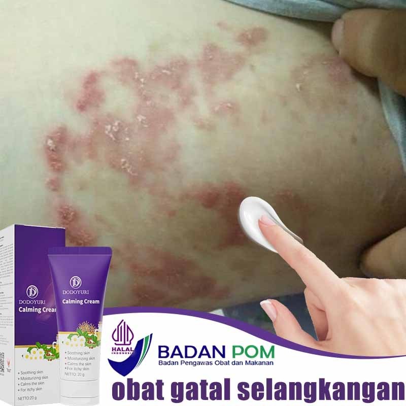 layla Salep gatal jamur selangkangan Obat gatal Salep gatal china paling ampuh Obat gatal