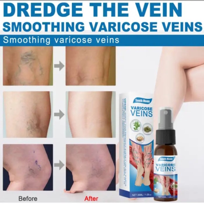 Ori South Moon Vs Eelhoe Krim Varises Semprotan Varises Mengurangi Varises Spray Pengobatan Varises