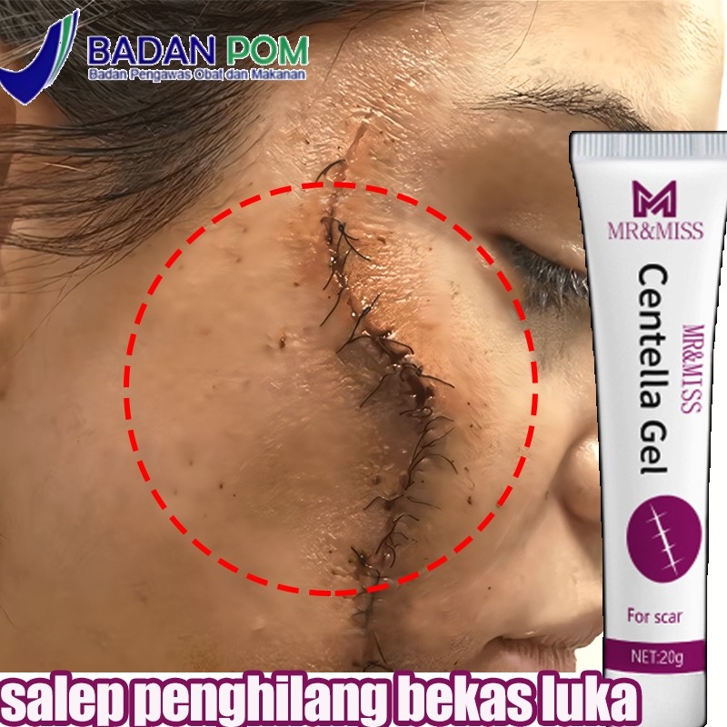 Salep penghilang bekas luka Obat penghilang bekas luka Salep penghilang bekas luka hitam Penghilang