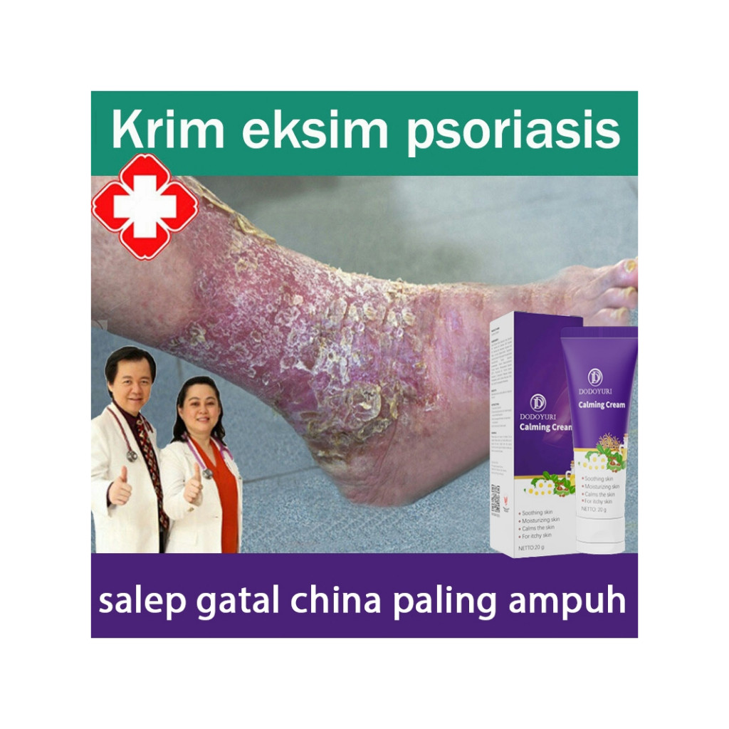 Obat gatal gatal seluruh badan obat gatal selangkangan salep gatal china paling ampuh 20g Obat gatal