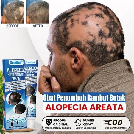 SALEP ALOPECIA AREATA BOTAK KOIN BOTAK ALOPECIA AREATA RAMBUT PITAK