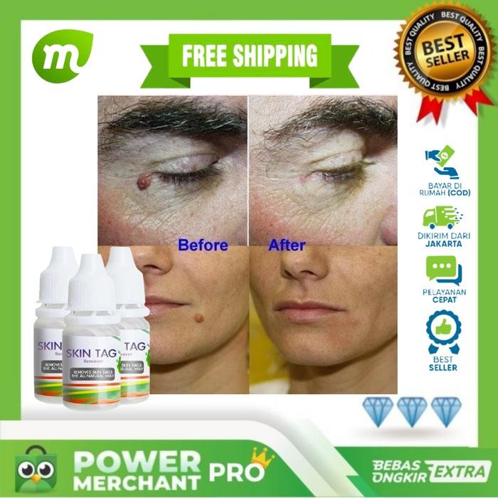 Obat Mata Ikan Ampuh - Obat Mata Ikan Di Telapak Kaki Dan Tangan