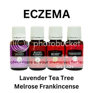 Eczema Blend Melrose Frankincense Lavender Tea Tree YL Essential Oil 5ml 10ml 15ml eksim gatal Roll 