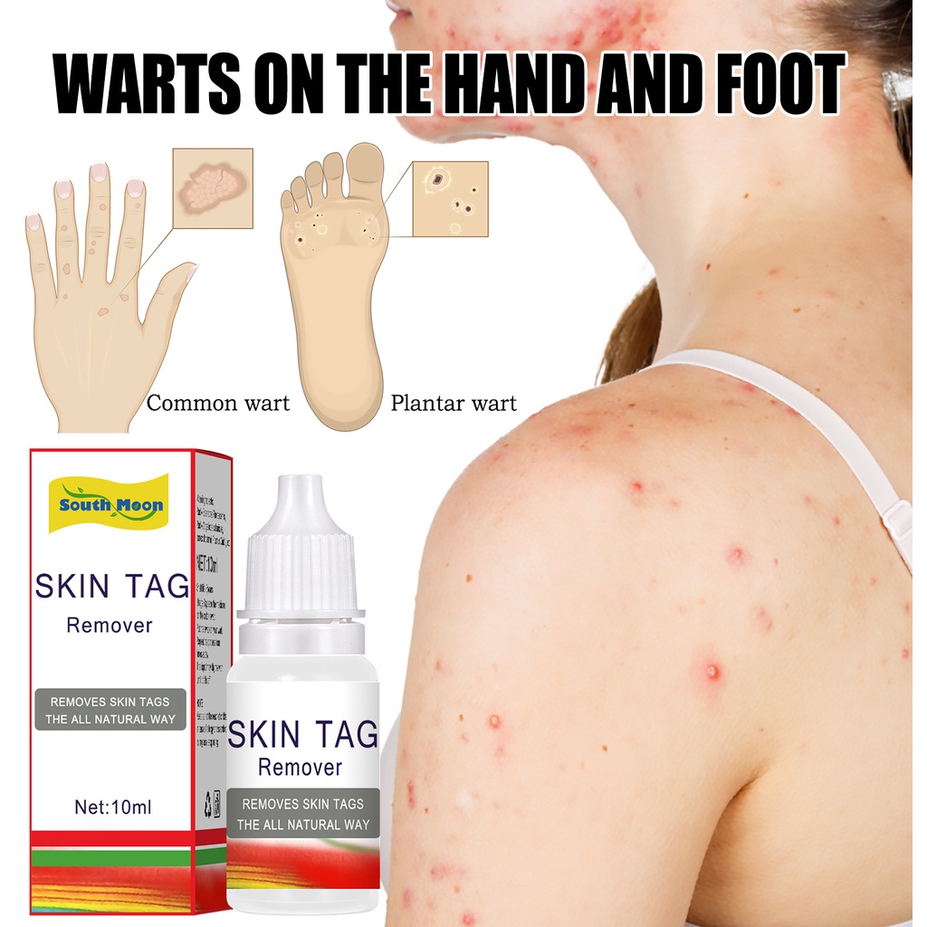 ORIGINAL Wart Remover | Skin Tags &amp; Moles Remover | Obat Penghilang Kutil | Menghilangkan Kutil Tahi Lalat Mata Ikan Permanen Ampuh 10ml