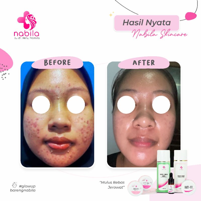 PREMIUM ACNE PACKAGE | PAKET JERAWAT PREMIUM | NABILA SKINCARE | SKINCARE PURWODADI | NABILA