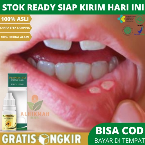 Obat Sariawan, Obat Sariawan Anak Dan Dewasa, Obat Sariawan di Bibir, Obat Sariawan Mulut, Obat Sari